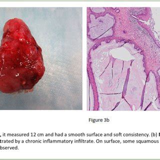 uterine polyps biopsy results